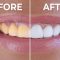 Whitening Solutions